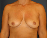 Feel Beautiful - Breast Implant Removal 200 - After Photo